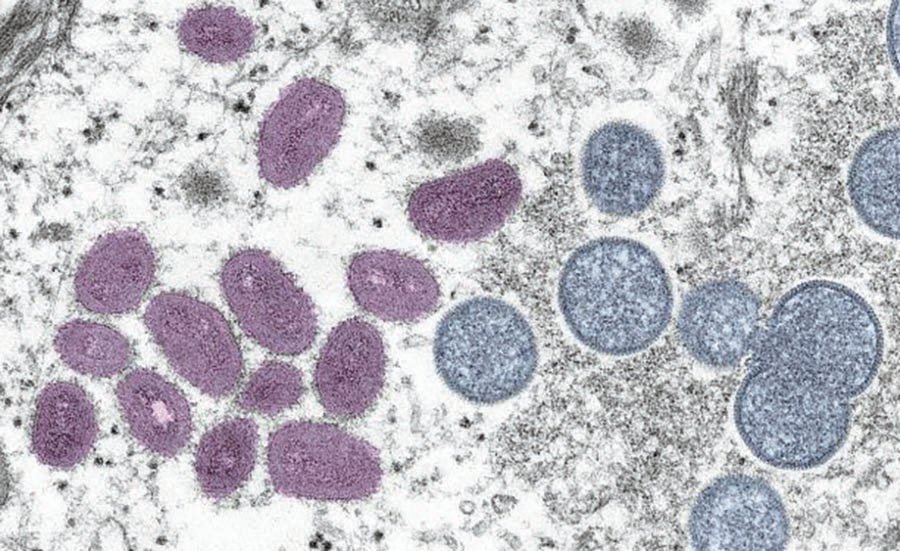 Digitally-colorized electron microscopic (EM) image depicting a monkeypox virion (virus particle), obtained from a clinical sample associated with a 2003 prairie dog outbreak, published June 6, 2022. The image depicts a thin section image from a human skin sample. On the left are mature, oval-shaped virus particles, and on the right are the crescents and spherical particles of immature virions.